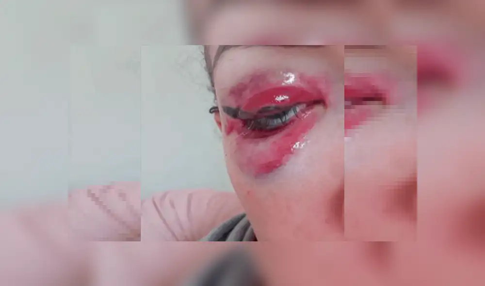Mujer termina con los párpados destrozados tras hacerse delineado permanente [FOTOS]