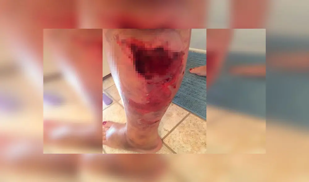 Mujer acaba con un agujero en la pierna tras someterse a una liposucción [FOTOS]