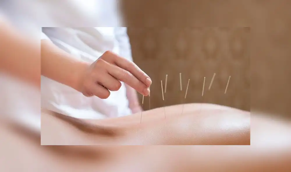 Acupuntura. Foto: difusión.