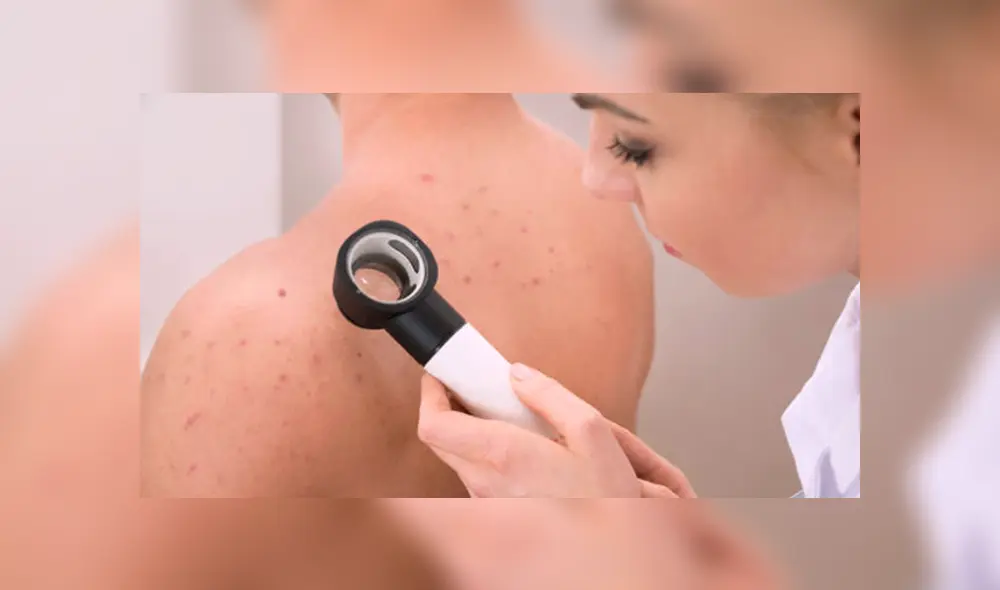 Manchas negras:¿Qué son y cómo curar sus apariciones en el cuello y axilas?