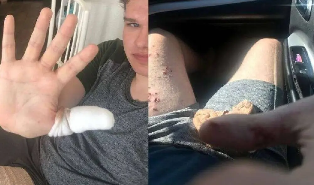 Nick sufrió heridas en su pierna y brazo tras el ataque del tiburón. Foto: Arthur Family / FOX8 Nick sufrió heridas en su pierna y brazo tras el ataque del tiburón. Foto: Arthur Family / FOX8