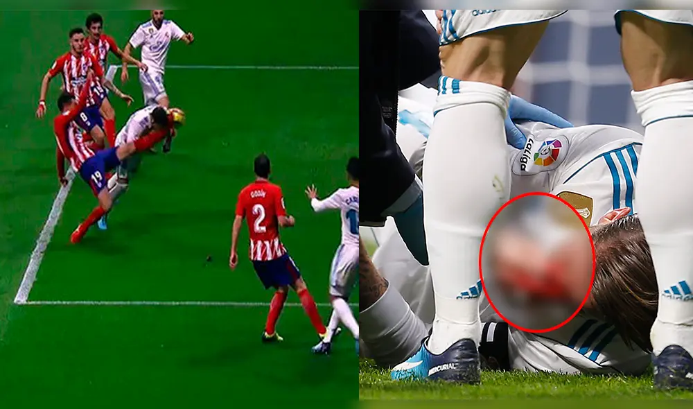 Real Madrid: así quedó la nariz de Sergio Ramos tras la patada que sufrió [FOTOS]