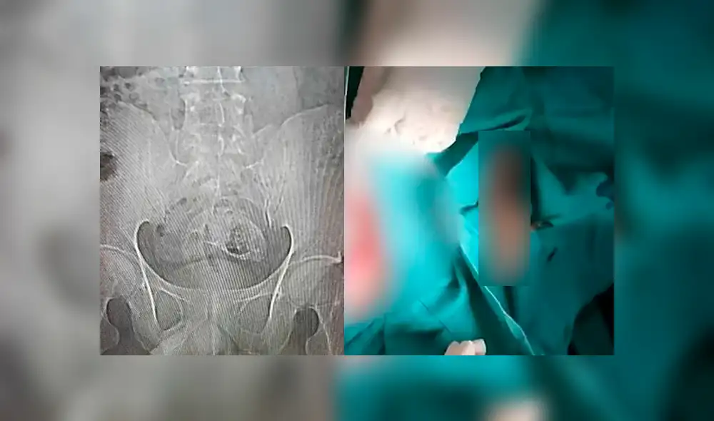 Un equipo de médicos operó a un hombre para sacar de su cuerpo un pez en el que se sentó accidentalmente. Foto: Composión/Daily Mail