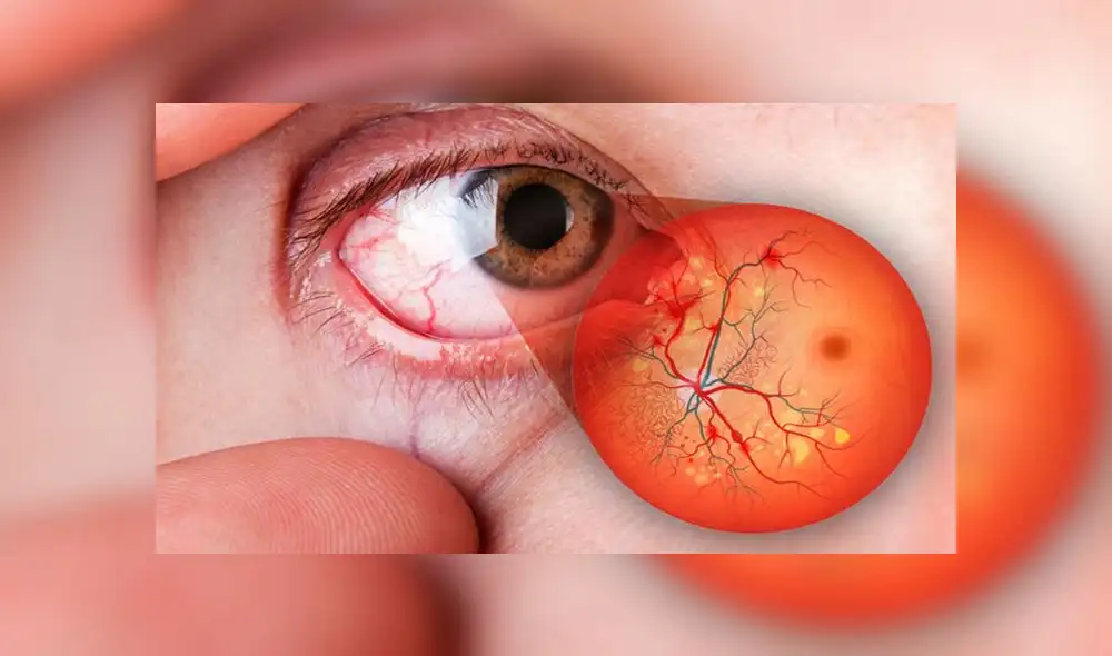 Conoce el daño que puede causar la diabetes en la vista