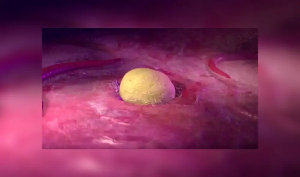 Edith González: ¿Cuáles son los síntomas del cáncer de ovario? 