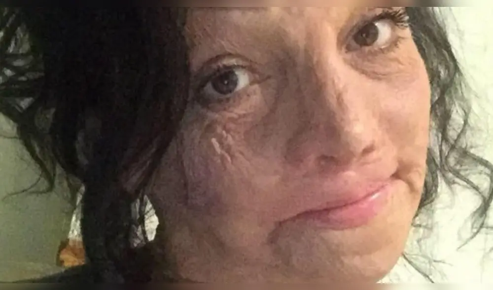 Stasi Manser logró superar numerosas cirugías para la reconstrucción de su rostro, cuello, brazos y piernas. (Foto: Difusión)