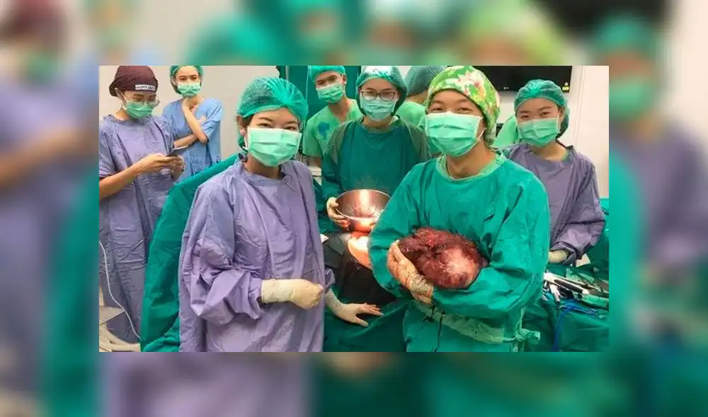Enfermeras y asistentes con el tumor de 5 kilos en mano. Foto: Viral Press. Enfermeras y asistentes con el tumor de 5 kilos en mano. Foto: Viral Press.