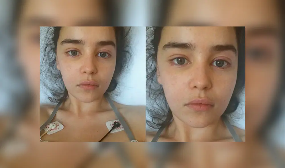 Emilia Clarke comparte fotos de su postoperación por aneurisma cerebral