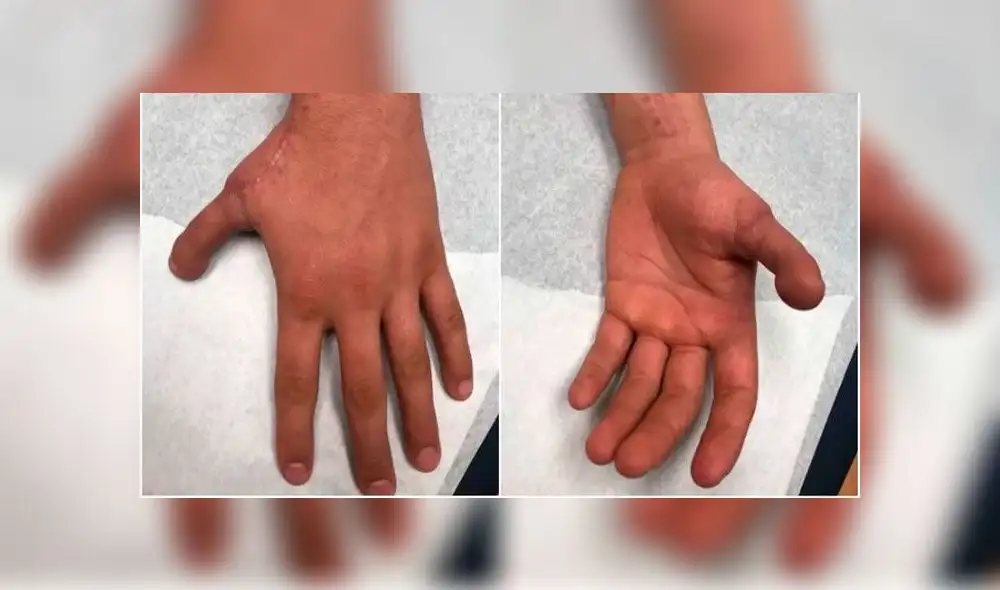 Cirujanos extirpan dedo del pie a paciente para reemplazar el pulgar de su mano [FOTOS]