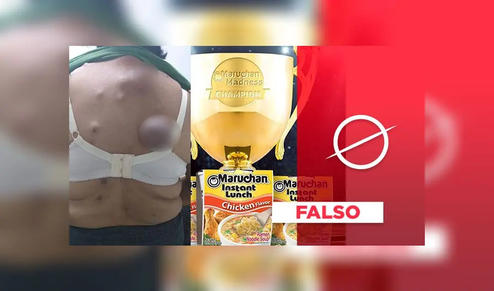 Los tumores de la foto viral no fueron causados por tomar sopa instantánea Los tumores de la foto viral no fueron causados por tomar sopa instantánea