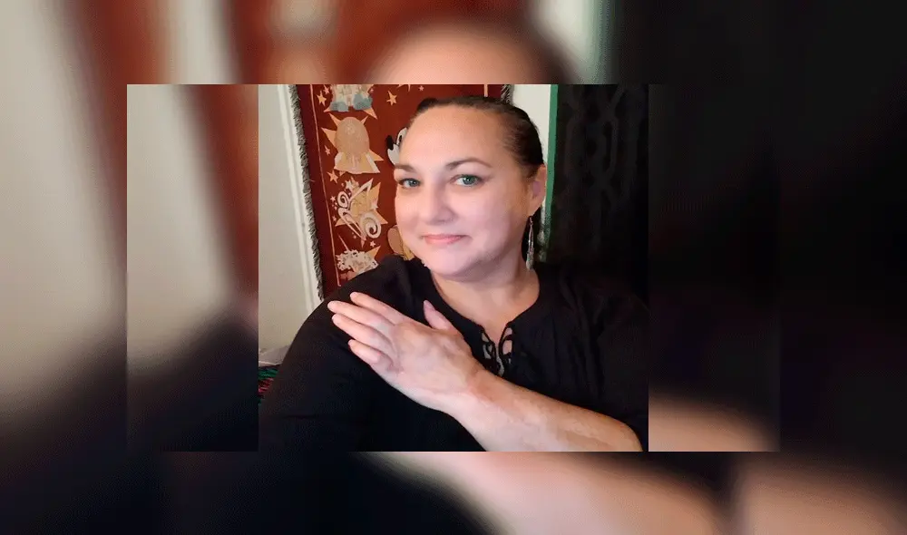 Contrajo bacteria carnívora al cortarse con un papel y quedó cerca de morir