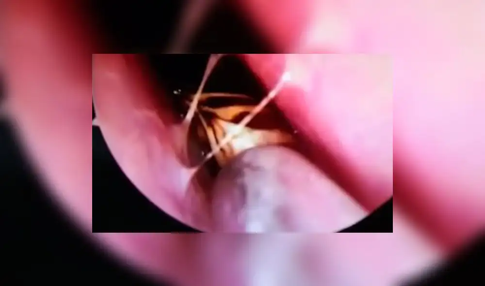 En YouTube, médicos encontraron una cucaracha viviendo dentro de la cabeza de una mujer | VIDEO