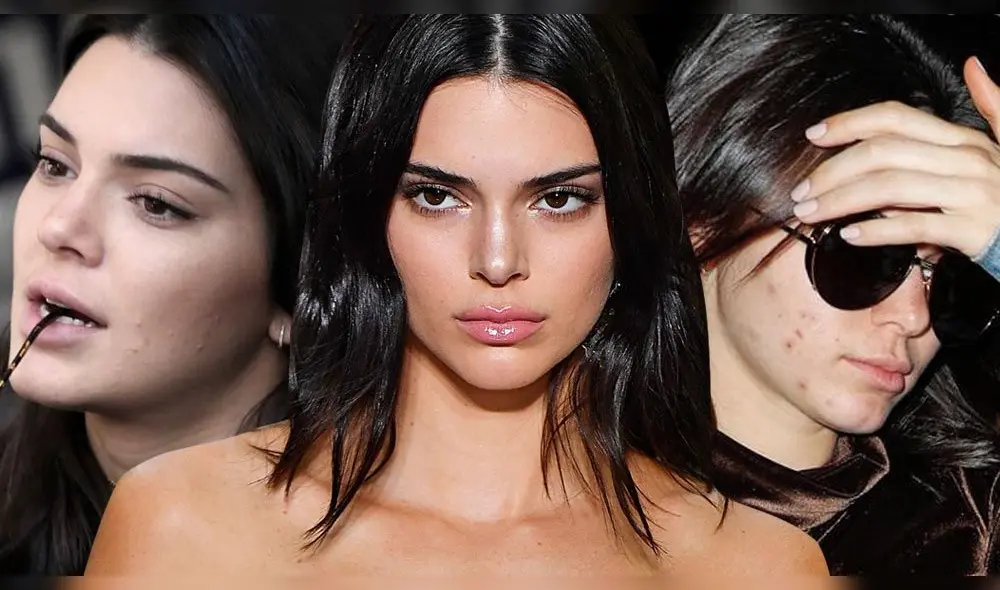 Kendall Jenner sufre por no poder ocultar las cicatrices del acné en su cara