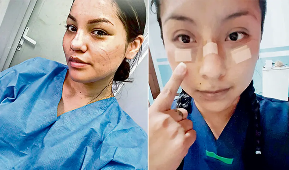 A la izquierda: Marcas de guerra. Médica Yudira Chacón luego de una dura jornada, como la que tuvo en su reciente cumpleaños. A la derecha: Cicatrizando. Médica Gilary Maquito paliando daños del equipo de protección, que algunos no resistían al inicio. A la izquierda: Marcas de guerra. Médica Yudira Chacón luego de una dura jornada, como la que tuvo en su reciente cumpleaños. A la derecha: Cicatrizando. Médica Gilary Maquito paliando daños del equipo de protección, que algunos no resistían al inicio.