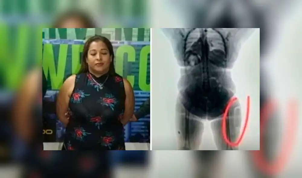 Mujer pretendía llegar a Madrid con cocaína implantada en sus muslos. Foto: AFP. Mujer pretendía llegar a Madrid con cocaína implantada en sus muslos. Foto: AFP.