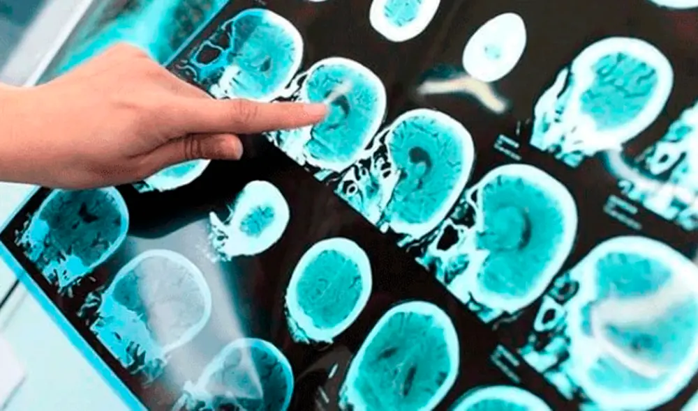 Encuentran posible cura del Alzheimer en mutación del gen de una mujer en Colombia. (Fuente: difusión) Encuentran posible cura del Alzheimer en mutación del gen de una mujer en Colombia. (Fuente: difusión)