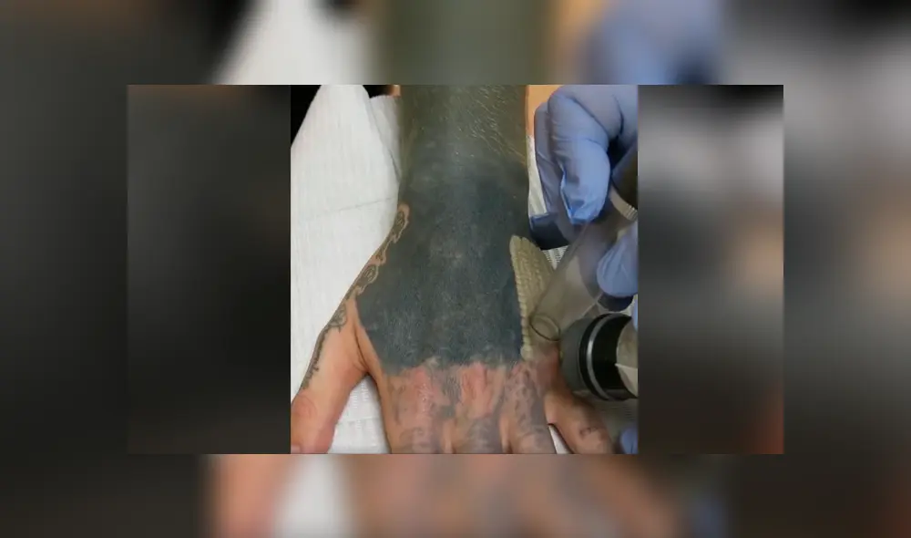 Facebook viral: joven decide quitarse tatuaje del brazo, sin imaginar el terrible resultado que tendría
