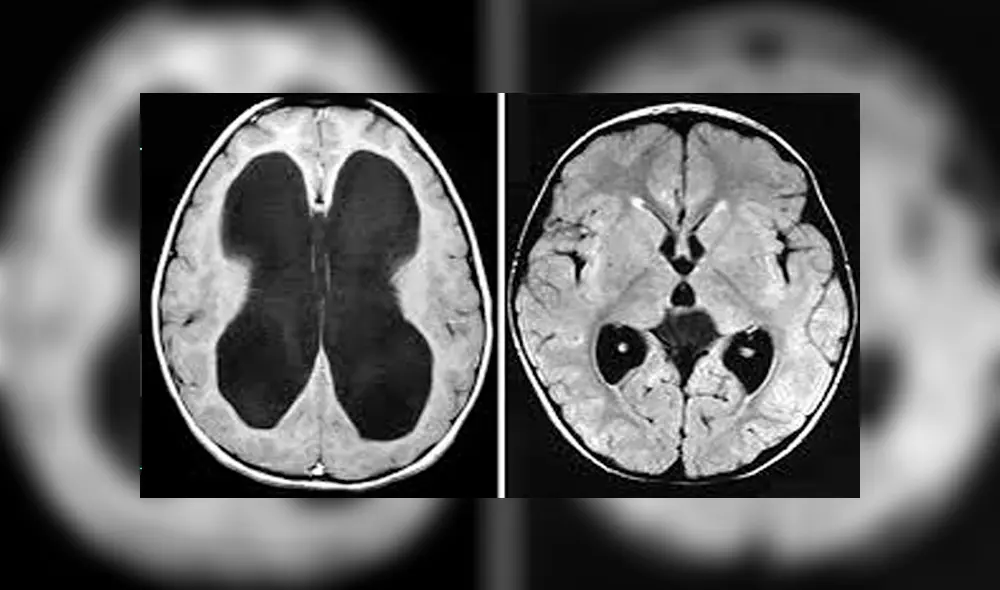Este síndrome es difícil de diagnostica por su parecido con el Parkinson y Alzheimer. Créditos: Difusión