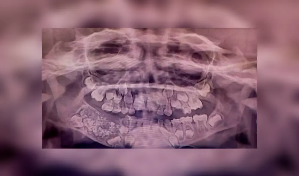 Niño de 7 años fue víctima de afección por la que tenía unos 500 dientes dentro de tumor. Foto: Instituto de Ciencias Médicas y Técnicas Saveetha Niño de 7 años fue víctima de afección por la que tenía unos 500 dientes dentro de tumor. Foto: Instituto de Ciencias Médicas y Técnicas Saveetha