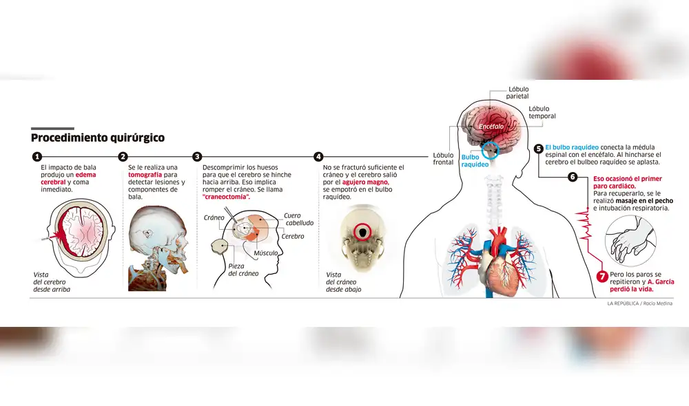 Muerte de Alan García: Procedimiento quirúrgico [INFOGRAFÍA] 