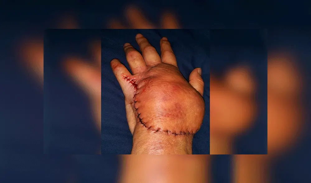 Contrajo bacteria carnívora al cortarse con un papel y quedó cerca de morir