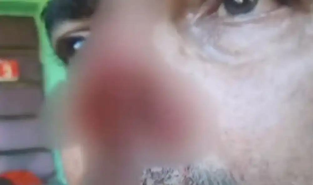 Gran parte de la nariz del hombre quedó destrozada. Foto: NPY