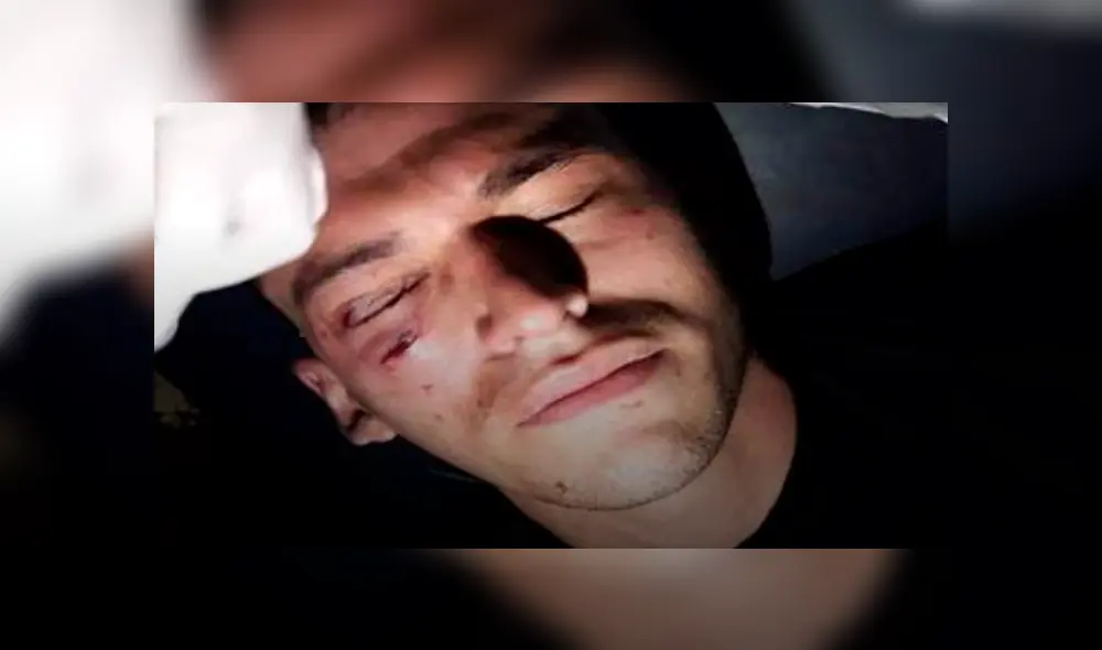 Arquero recibió brutal golpe en la cara y terminó con un edema en la retina [VIDEO]