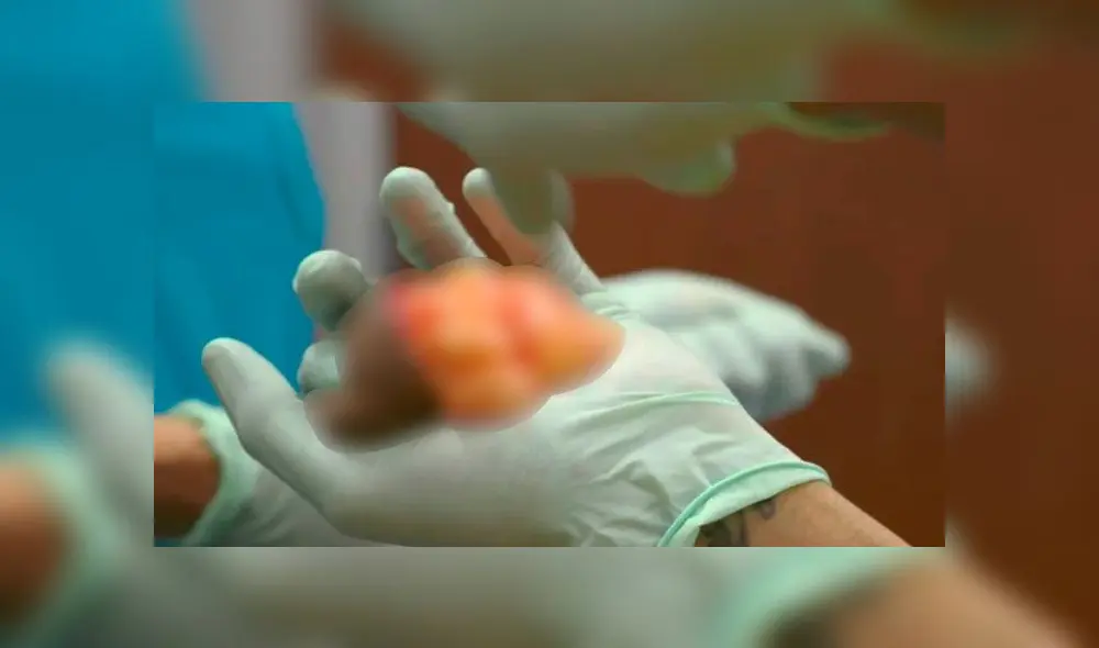 Médico le extirpa un “tercer testículo” a joven luego de un extraño crecimiento [VIDEO]