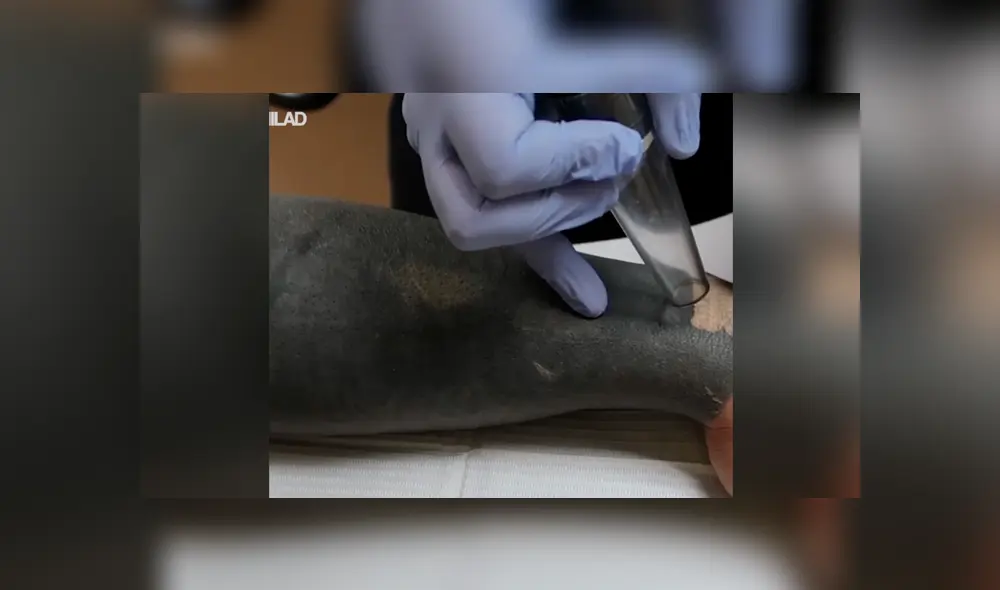 Facebook viral: joven decide quitarse tatuaje del brazo, sin imaginar el terrible resultado que tendría