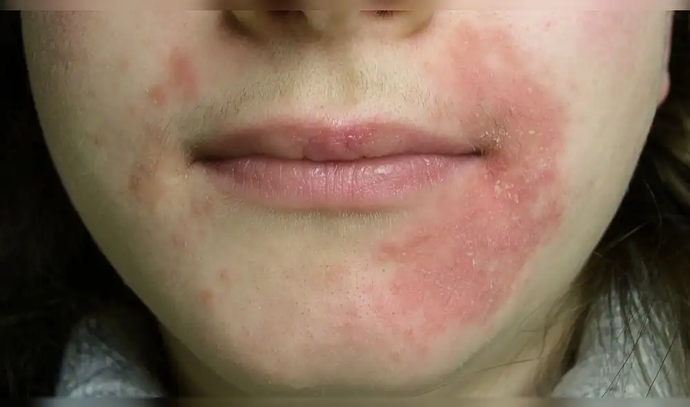 Rosácea, fragilidad de los vasos sanguíneos del rostro