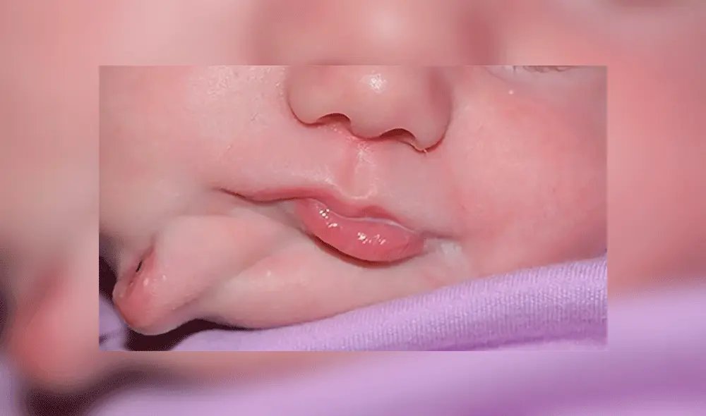 La condición que presentó la pequeña solo se registró 35 veces desde 1900. Fuente: BMJ Cases. La condición que presentó la pequeña solo se registró 35 veces desde 1900. Fuente: BMJ Cases.