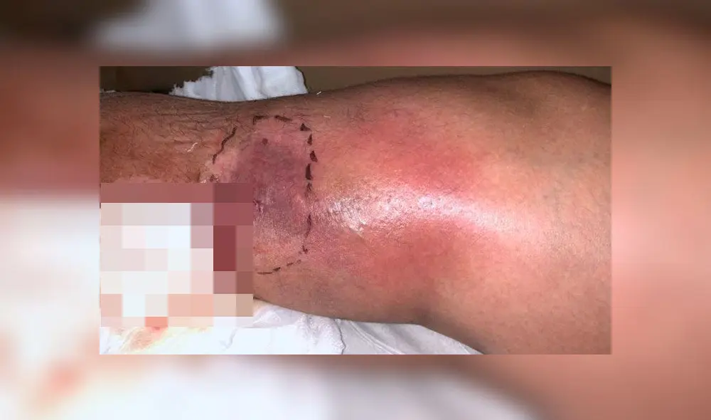 Mujer acaba con un agujero en la pierna tras someterse a una liposucción [FOTOS]