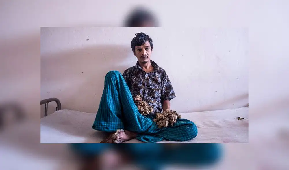 Abul Bajandar fue conocido en 2016 como el 'hombre árbol' y hoy hace triste pedido. Foto: AFP Abul Bajandar fue conocido en 2016 como el 'hombre árbol' y hoy hace triste pedido. Foto: AFP