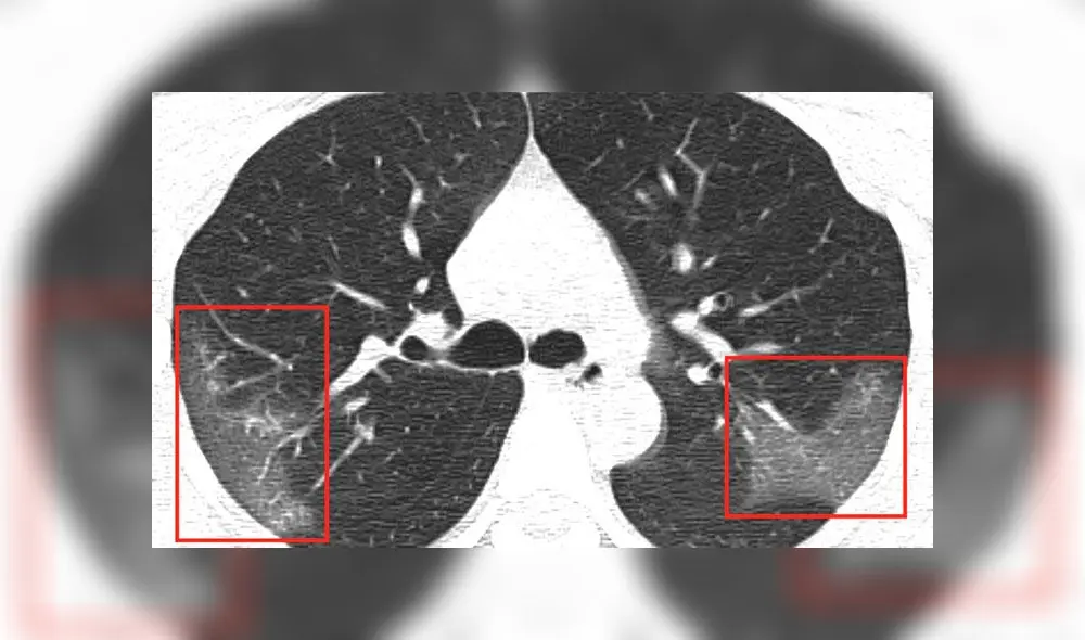 Las manchas blancas se extienden hasta los bordes de los pulmones de la paciente infectada por el coronavirus 2019-nCoV. Crédito: First Hospital of Lanzhou University.