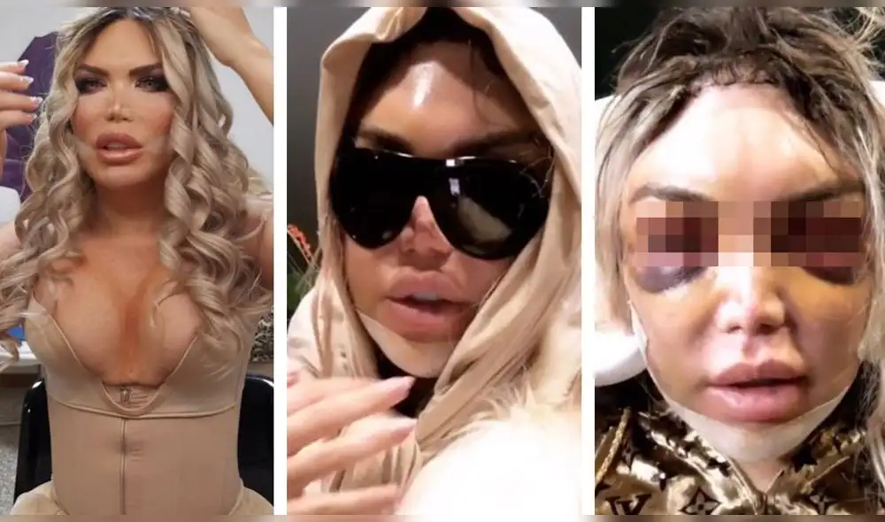 Rodrigo Alves, ahora una celebridad trans, se sometió a una cirugía de feminización facial. Foto: Captura. Rodrigo Alves, ahora una celebridad trans, se sometió a una cirugía de feminización facial. Foto: Captura.