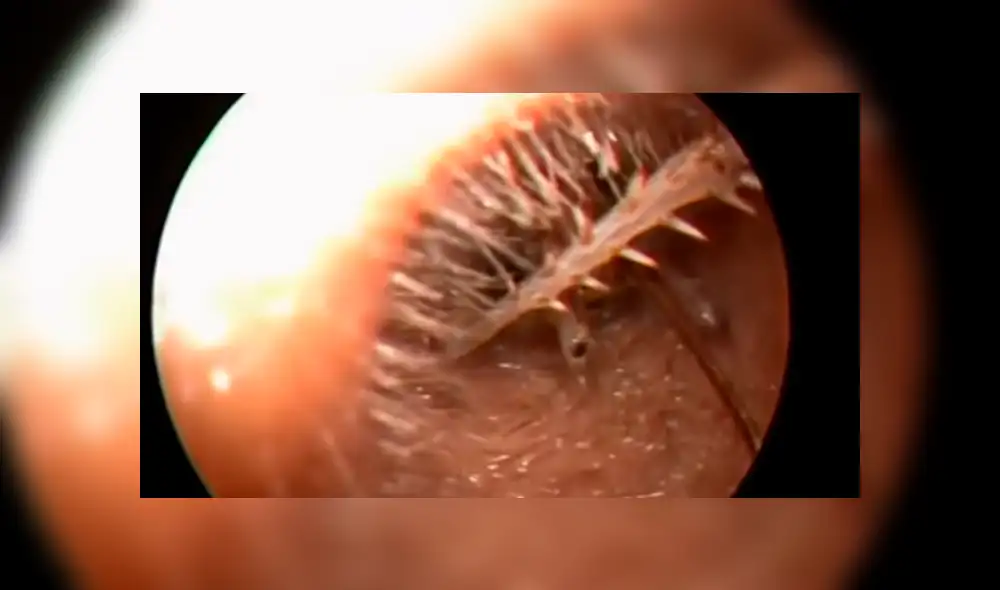 YouTube viral: médico encuentra 'misteriosa criatura' dentro de oído que genera terror [VIDEO]