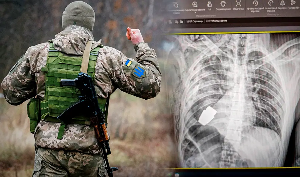 Los especialistas no entienden cómo el hombre pudo una granada activa VOG dentro sin detonar. Foto: composición LR / BBC News Mundo