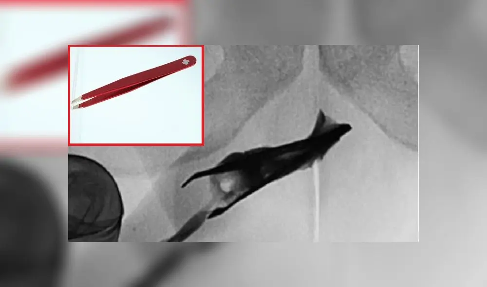 El joven dijo que las pinzas nunca le causaron problemas urinarios. Foto: composición El joven dijo que las pinzas nunca le causaron problemas urinarios. Foto: composición