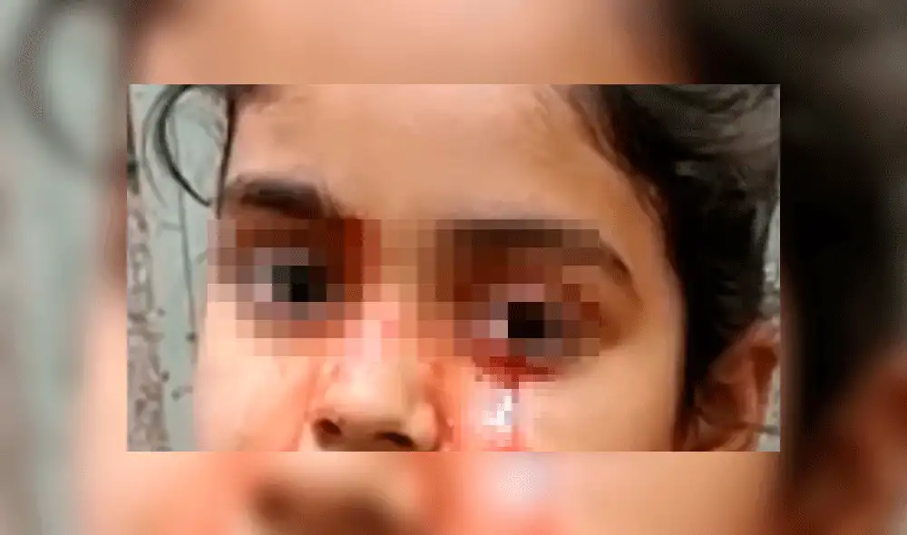 La pequeña emite las lágrimas con sangre diariamente. Foto: BMJ Case Reports. La pequeña emite las lágrimas con sangre diariamente. Foto: BMJ Case Reports.