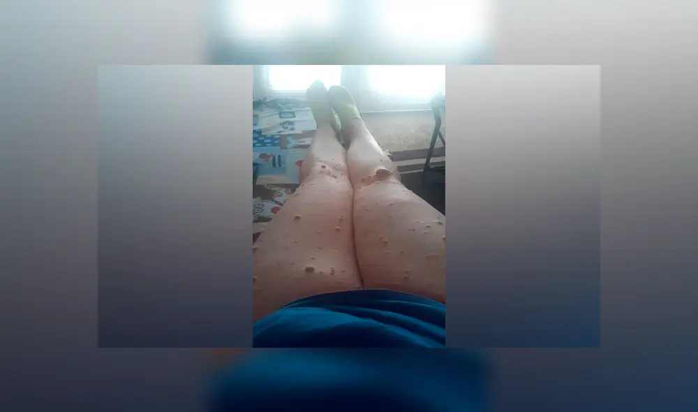 La madre de familia padece de neurofibromatosis, un trastorno genético que ha provocado en su cuerpo el desarrollo de miles de tumores no contagiosos. La madre de familia padece de neurofibromatosis, un trastorno genético que ha provocado en su cuerpo el desarrollo de miles de tumores no contagiosos.