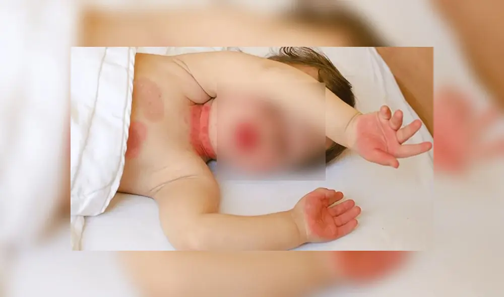 Menor con síndrome de Kawasaki. Créditos: BAE Negocios. Menor con síndrome de Kawasaki. Créditos: BAE Negocios.