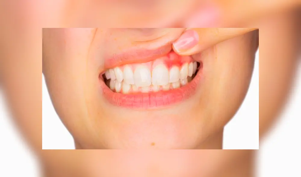 ¿Cómo se genera la gingivitis y cuál es el tratamiento?