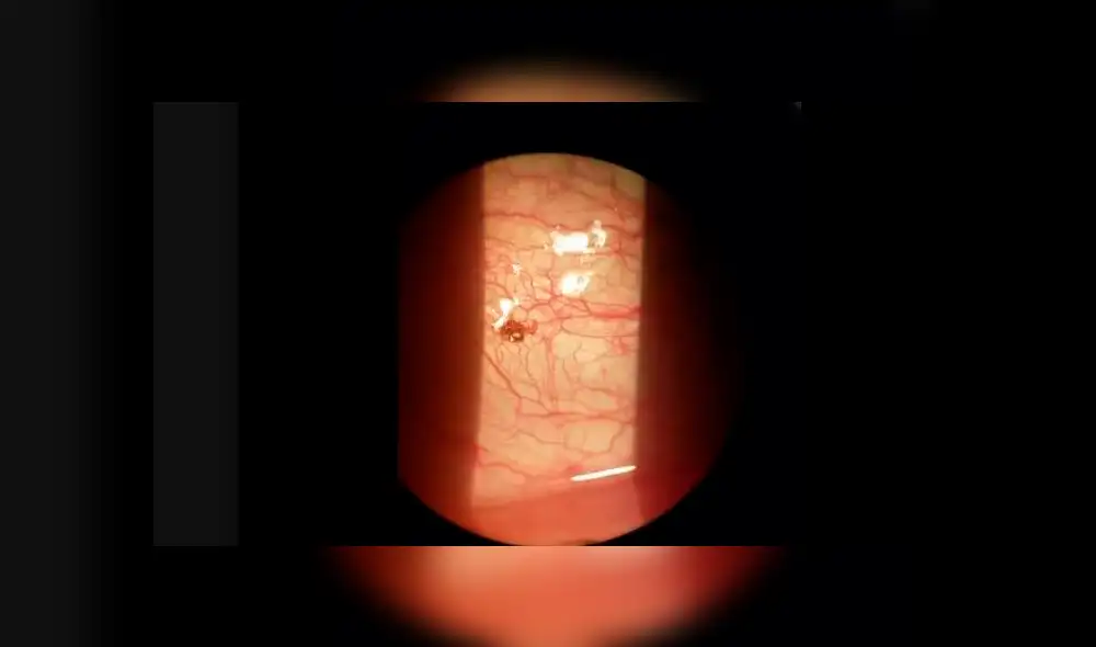 El bicho hizo un ruido como un pequeño estallido cuando la retiraron. Foto: captura