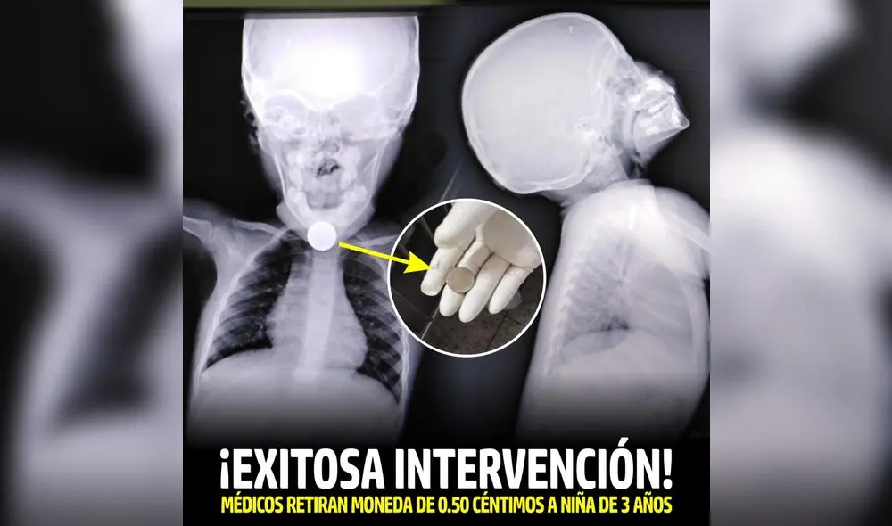 Niña se salvó de morir luego de tragar una moneda de 50 céntimos