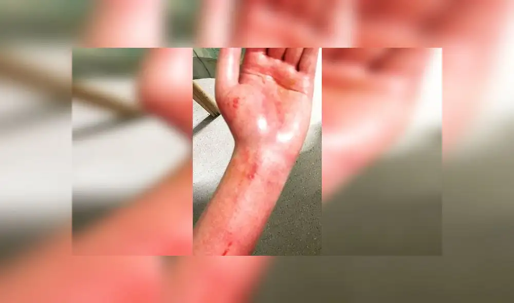 Mujer pierde el brazo luego de electrocutarse al tratar de enchufar su laptop [FOTOS]