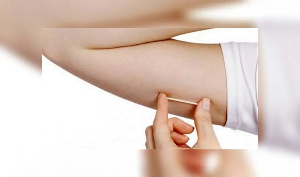 El implante subdérmico es una pequeña varilla flexible que se coloca debajo de la piel que libera lenta y constantemente progestágeno en el torrente sanguíneo. (Foto: Difusión) El implante subdérmico es una pequeña varilla flexible que se coloca debajo de la piel que libera lenta y constantemente progestágeno en el torrente sanguíneo. (Foto: Difusión)