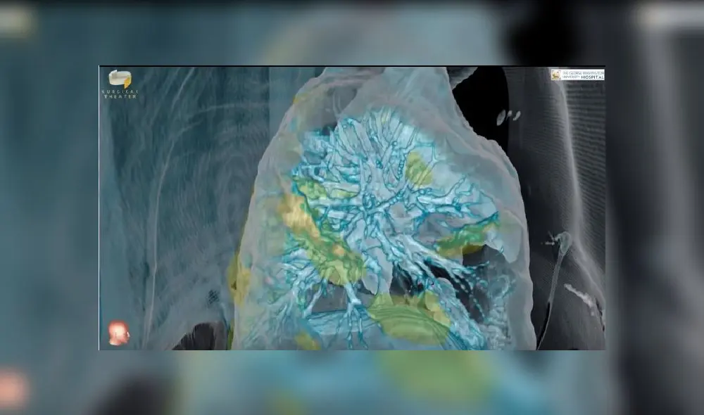 Coronavirus y pulmones Coronavirus y pulmones