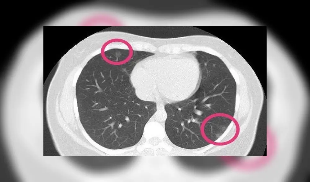 Una mujer de 30 años tenía parches que se asemejan al vidrio esmerilado, resultado de la neumonía que causa el coronavirus. Foto: Radiopaedia