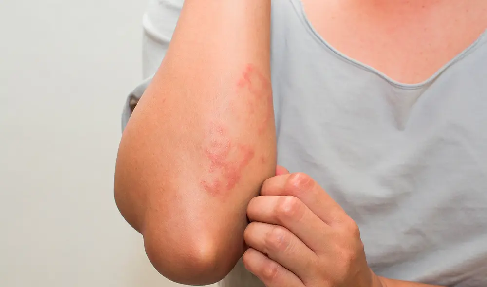 La psoriasis, enfermedad que muchos consideran contagiosa. Foto: Difusión