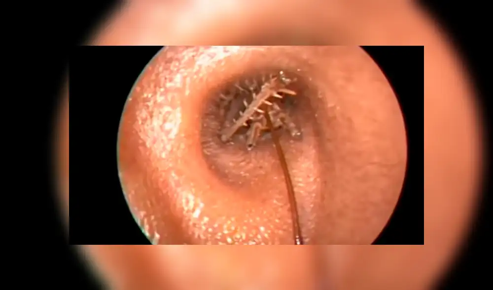 YouTube viral: médico encuentra 'misteriosa criatura' dentro de oído que genera terror [VIDEO]